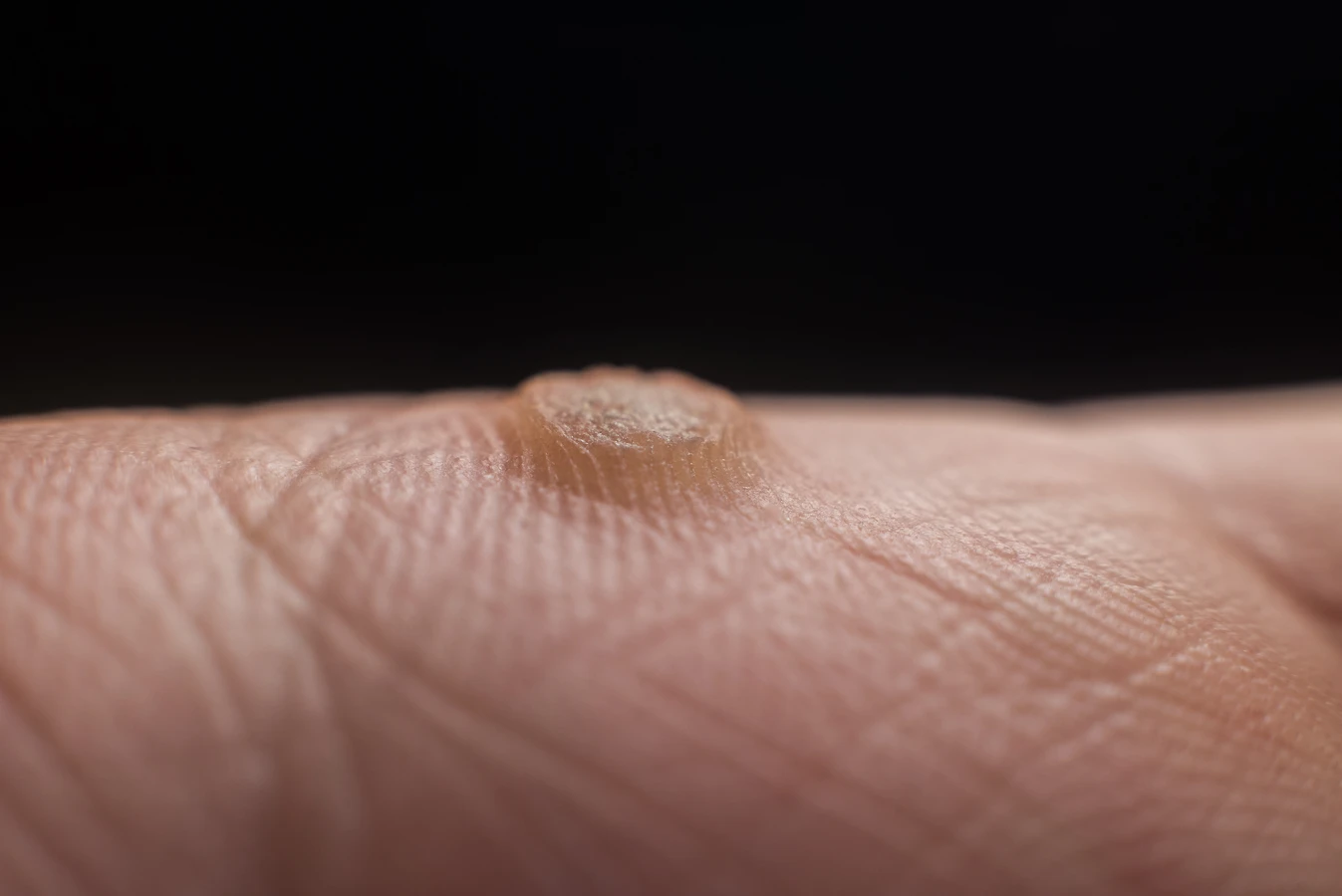 Co na kurzajki u dzieci?