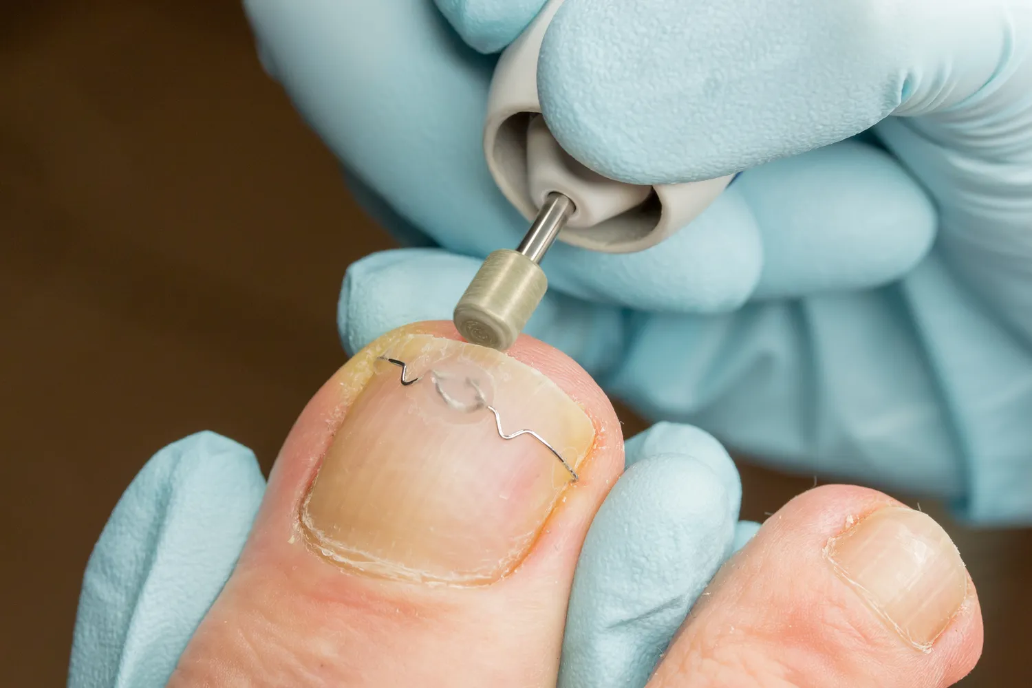 Ile kosztuje usunięcie odcisku u podologa?