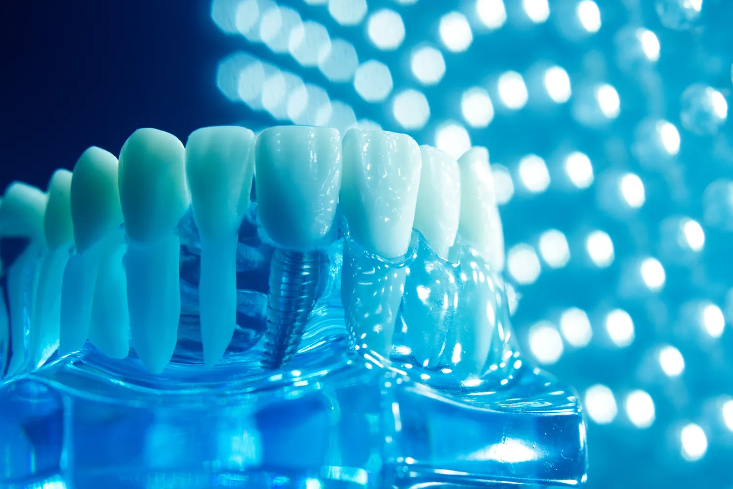 Jakie są najlepsze implanty zębowe?